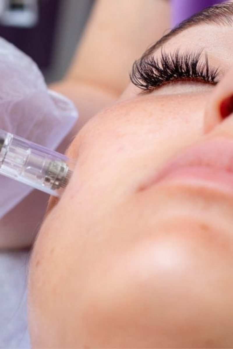 MNRF-treatment-in-chennai