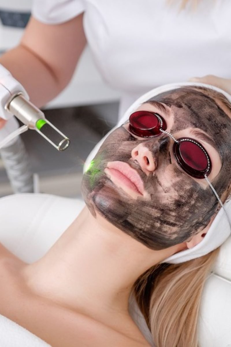 carbon-laser-facial
