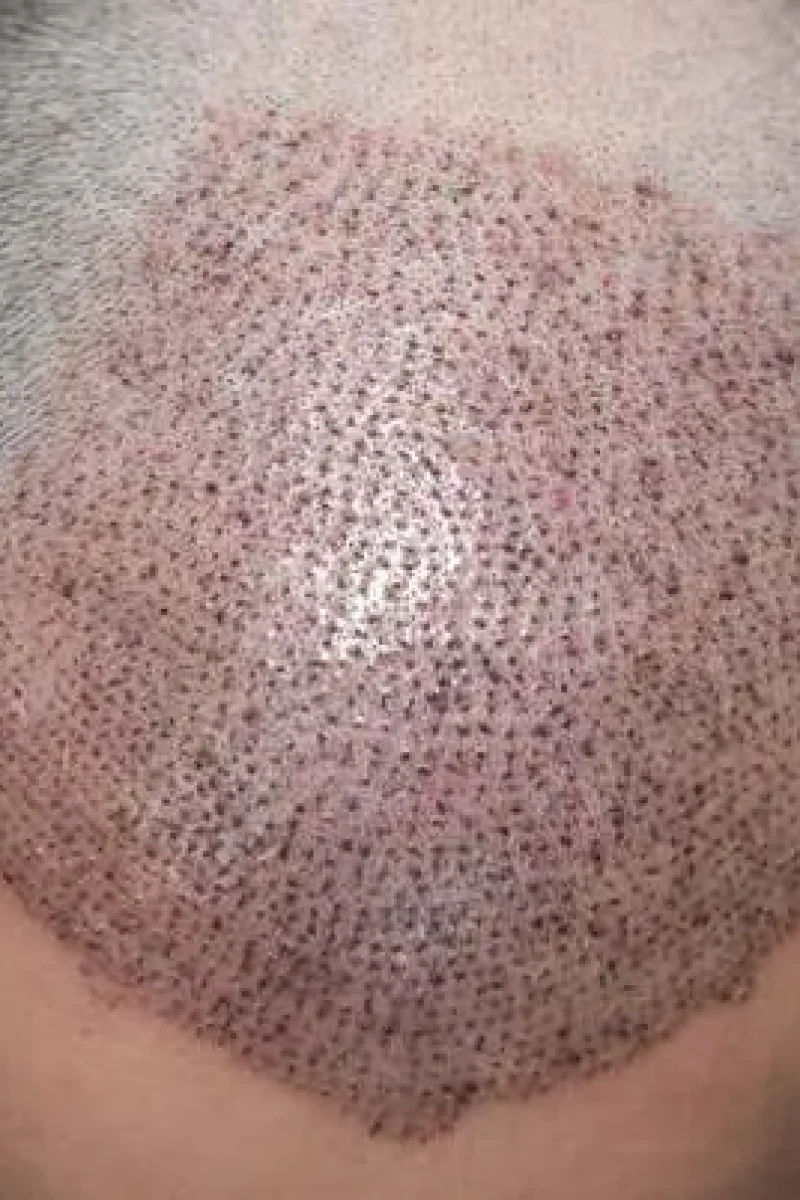 hair-transplant-5_cs