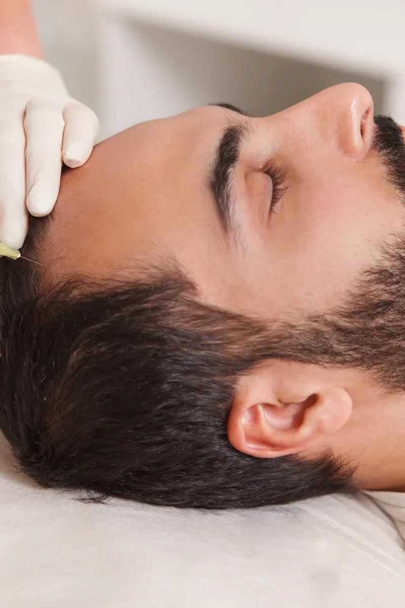 mesotherapy