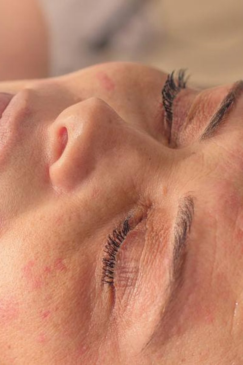 microneedling-treatment